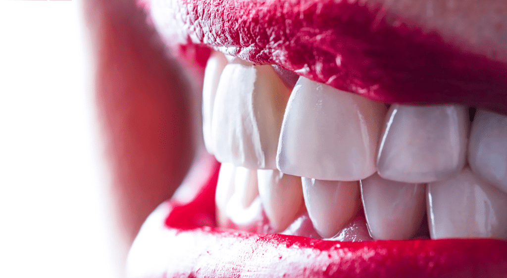 Porcelain Veneers, Emax Veneers, Veneers in Los Gatos, Veneers in San Jose, Veneers in Campbell, Bay Area California Veneers